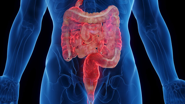 3D medical illustration of a man's intestines affected by Crohn's disease