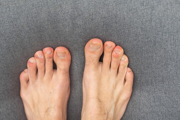 Fototapeta premium man toes with hair and dirty toenails.