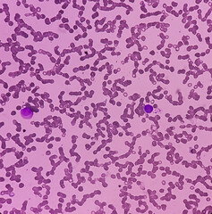 Acute promyelocytic leukemia(APL, APML). Blast cells, a type of blood cancer, an aggressive type of...