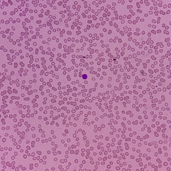 Acute promyelocytic leukemia(APL, APML). Blast cells, a type of blood cancer, an aggressive type of...
