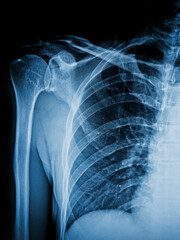 X-Ray Image Of Human Chest for a medical diagnosis