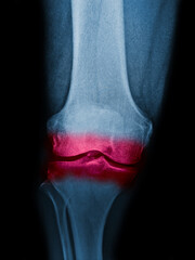 Osteoarthritis knee . film x-ray AP