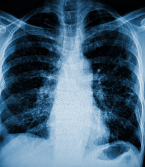 X-Ray Image Of Human Chest for a medical diagnosis