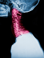 film x-ray skull lateral view and neck pain