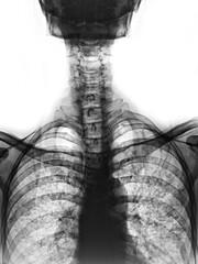 X-ray of normal human skull AP.