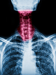film x-ray skull lateral view and neck pain