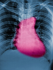 x ray chest showing lungs and heart