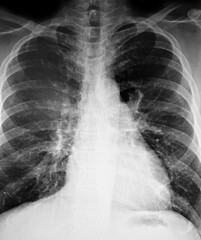 x ray chest showing lungs and heart