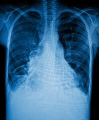 X-Ray Image Of Human Chest for a medical diagnosis
