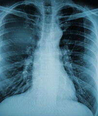 X-Ray Image Of Human Chest for a medical diagnosis