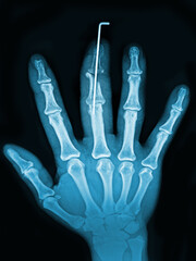 x ray image of hand
