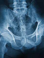 Film x-ray of human pelvis both hip