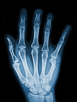 x ray image of hand