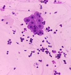 Photomicrograph of urine microscopy, urine cytology, Pap stain. Shows epithelial cells, neutrophils and occasional histiocytes.