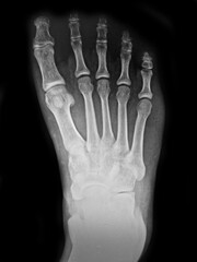film X-ray show bone of human's foot