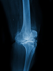 x ray image of knee