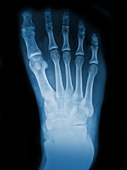 film X-ray show bone of human's foot