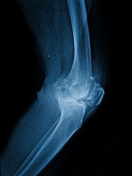 x ray of a knee