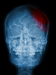 x ray of human skull