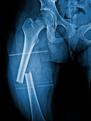 Film X-ray femur show complete fracture shaft of femur and displace