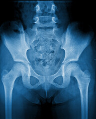 Film x-ray pelvis of patient