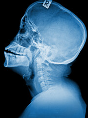 Film x-ray skull and spine of patient