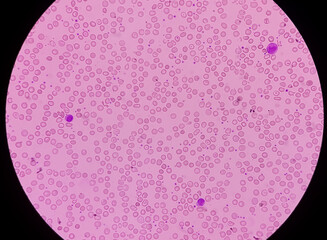 Congenital hemolytic anemias (CHAs). Anisocytosis anisochromia with echinocytes, target cell,...