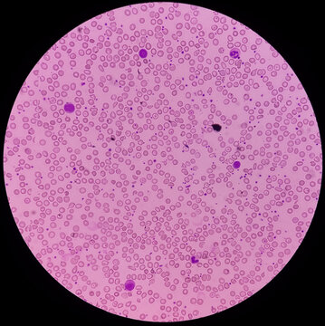 Congenital hemolytic anemias (CHAs). Anisocytosis anisochromia with echinocytes, target cell, schistocytes and nRBC seen. Thrombocytosis. Erythrocyte cytoskeleton disorders.