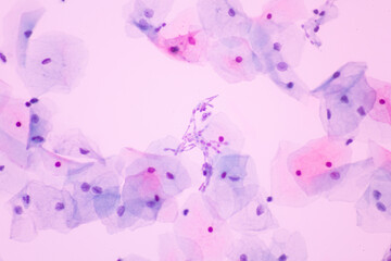 Fototapeta na wymiar View in microscopic of Candidiasis, fungus infection (Yeast and Pseudohyphae form) in pap smear slide cytology and diagnostic by pathologist.Gynecology report and diagnosis.Medical concept.