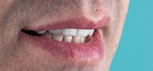 Obraz premium press ceramic crowns and veneers