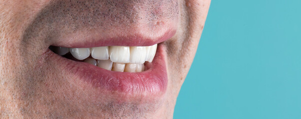 Obraz premium press ceramic crowns and veneers