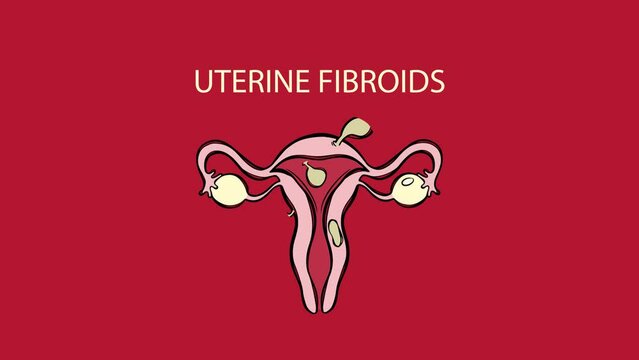 UTERINE FIBROIDS VIDEO Leiomyoma Benign Tumor Of The Smooth Muscles Of The Uterus Painful Or Severe Menstruation Medical Animation Education Banner For Teaching