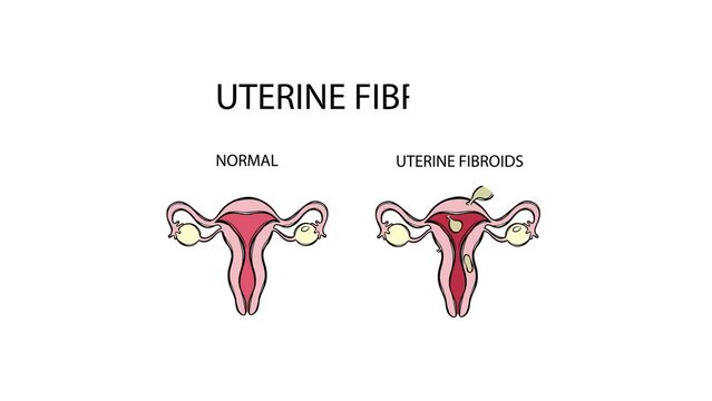 UTERINE FIBROIDS VS NORMAL VIDEO Leiomyoma Benign Tumor Of The Smooth Muscles Of The Uterus Painful Or Severe Menstruation Medical Animation Education Banner