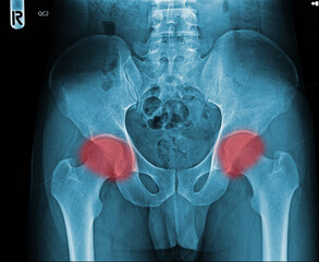 Film x-ray normal pelvis human anatomy