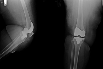 x-ray image of Joint replacement surgery