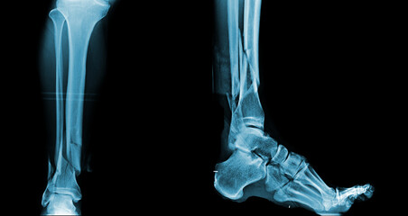 x-ray image of fracture leg bone . - Powered by Adobe