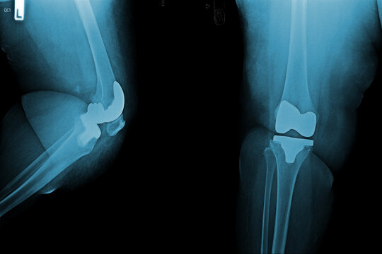 x-ray image of Joint replacement surgery