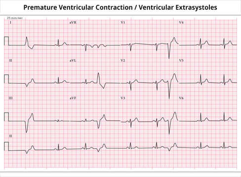 ECG PVC (Premature Ventricular Contractions) - ECG VES (Ventricular Extrasystoles) - 12 Leads ECG Paper