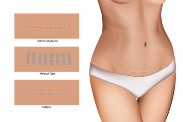 Closeup of incision with sutures. Wound closure devices Staples, Medical Tape and Stitches (Sutures). Surgical wound - obrazy, fototapety, plakaty