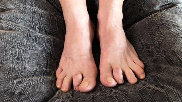 Mature white woman's foot with hammer toe deformity condition