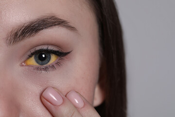 Woman with yellow eyes on light grey background, closeup. Symptom of hepatitis