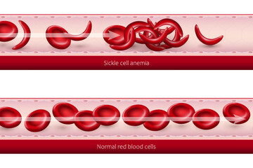 Comparing the blood flow of sickle cell anemia blood with normal red blood cells. Sickle cell disease.