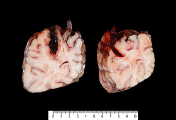 Human brain. Haemorrhagic stroke