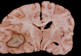 Human brain abscess - obrazy, fototapety, plakaty