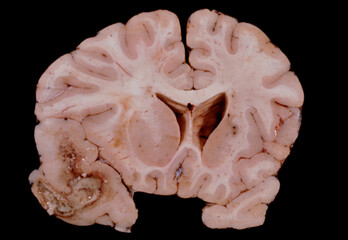 Human brain abscess