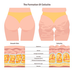 Cellulite and healthy skin structure. Herniation of subcutaneous fat within - obrazy, fototapety, plakaty