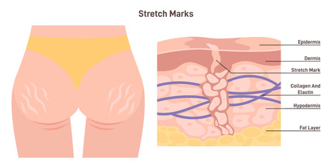 Fototapeta na wymiar Anatomy of skin with stretch marks. Skin stretches or shrinks quickly.