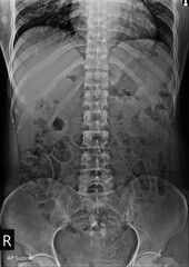 Film x-ray show abdomen disease
