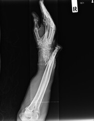 Film x-ray Complete fracture Forearm