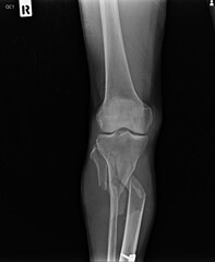 x ray of a foot